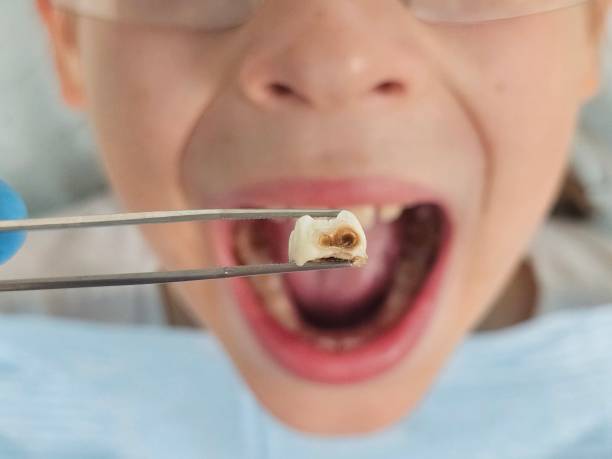 Best Emergency Treatment for Dental Infections or Abscesses in Waunakee, WI